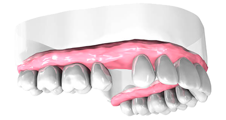 Pose implant dentaire - Cabinet dentaire des Marches du Velay - Monistrol-sur-Loire