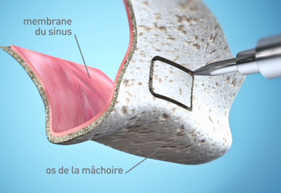 Sinus Lift - Cabinet dentaire des Marches du Velay - Monistrol-sur-Loire