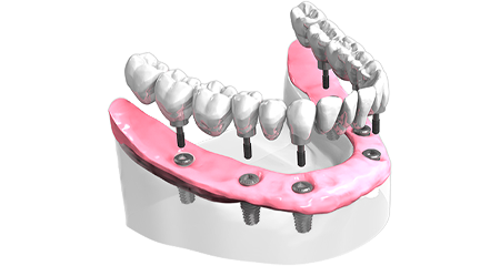 Pose implant dentaire - Cabinet dentaire des Marches du Velay - Monistrol-sur-Loire