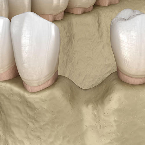 Chirurgie pré-implantaire - Cabinet dentaire des Marches du Velay - Monistrol-sur-Loire