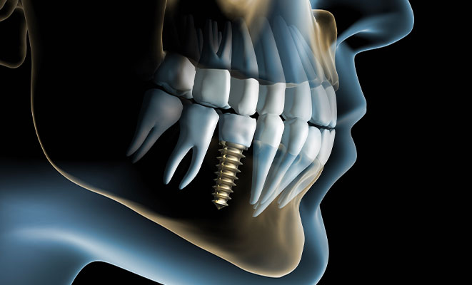 Implant dentaire - Cabinet dentaire des Marches du Velay - Monistrol-sur-Loire