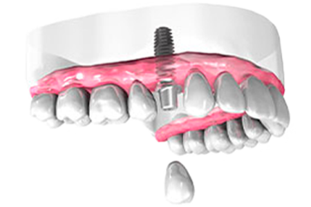 Pose implant dentaire - Cabinet dentaire des Marches du Velay - Monistrol-sur-Loire