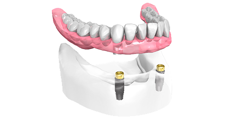 Pose implant dentaire - Cabinet dentaire des Marches du Velay - Monistrol-sur-Loire