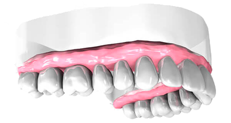 Pose implant dentaire - Cabinet dentaire des Marches du Velay - Monistrol-sur-Loire