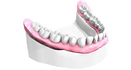 Pose implant dentaire - Cabinet dentaire des Marches du Velay - Monistrol-sur-Loire